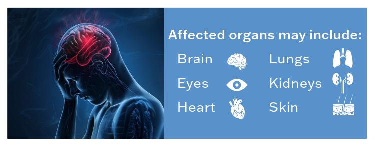 CDMRP-Funded Tuberous Sclerosis Complex Research Addresses TSC-Associated Epilepsy